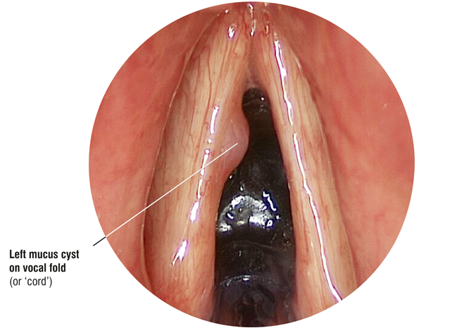 Laryngoscope image: mucus cyst on vocal fold