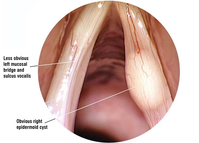 Laryngoscope image: mucosal bridge – epidermoid cyst