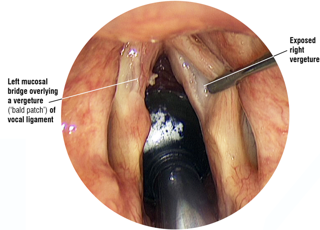 Laryngoscope image: vergature