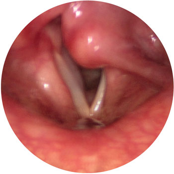 Left vocal fold paralysis close to the open (breathing) position