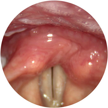 Vocal fold paralysis in voicing with potential for good closure