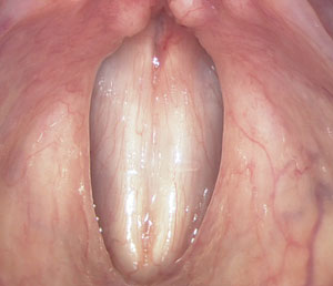 Normal vocal folds closed