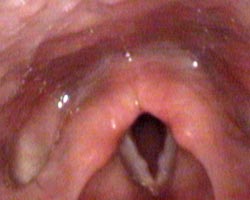 Nodules on a child's vocal folds