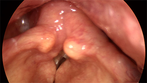 Bowing vocal folds with false fold recruitment