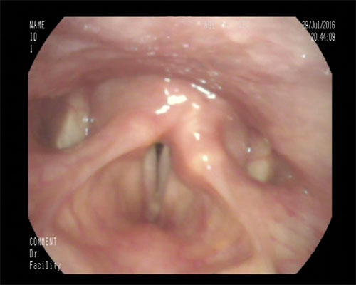 Bowing vocal folds following injection