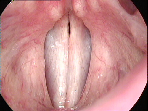 Normal vocal folds, closed