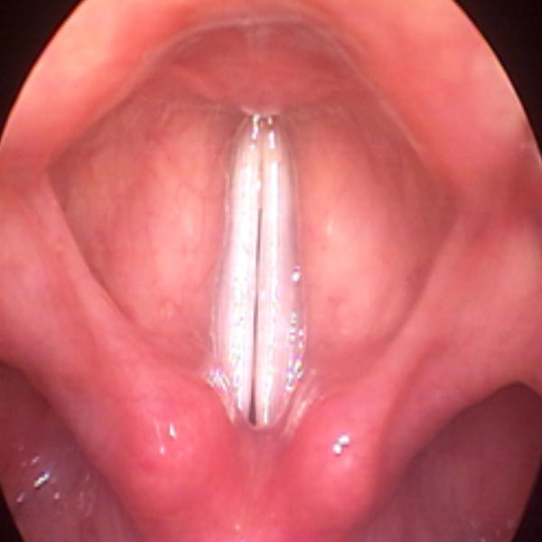 Healthy larynx producing voice